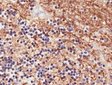 Alzheimer's disease