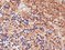 Alzheimer's disease